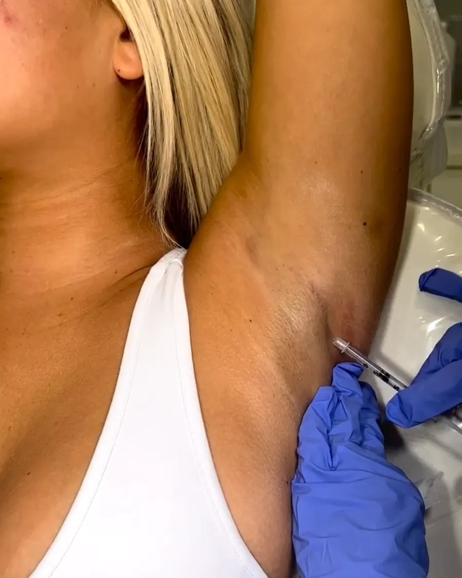 Botox injection in the underarm to stop excessive sweating at Cosmetica Med Spa in Boca Raton