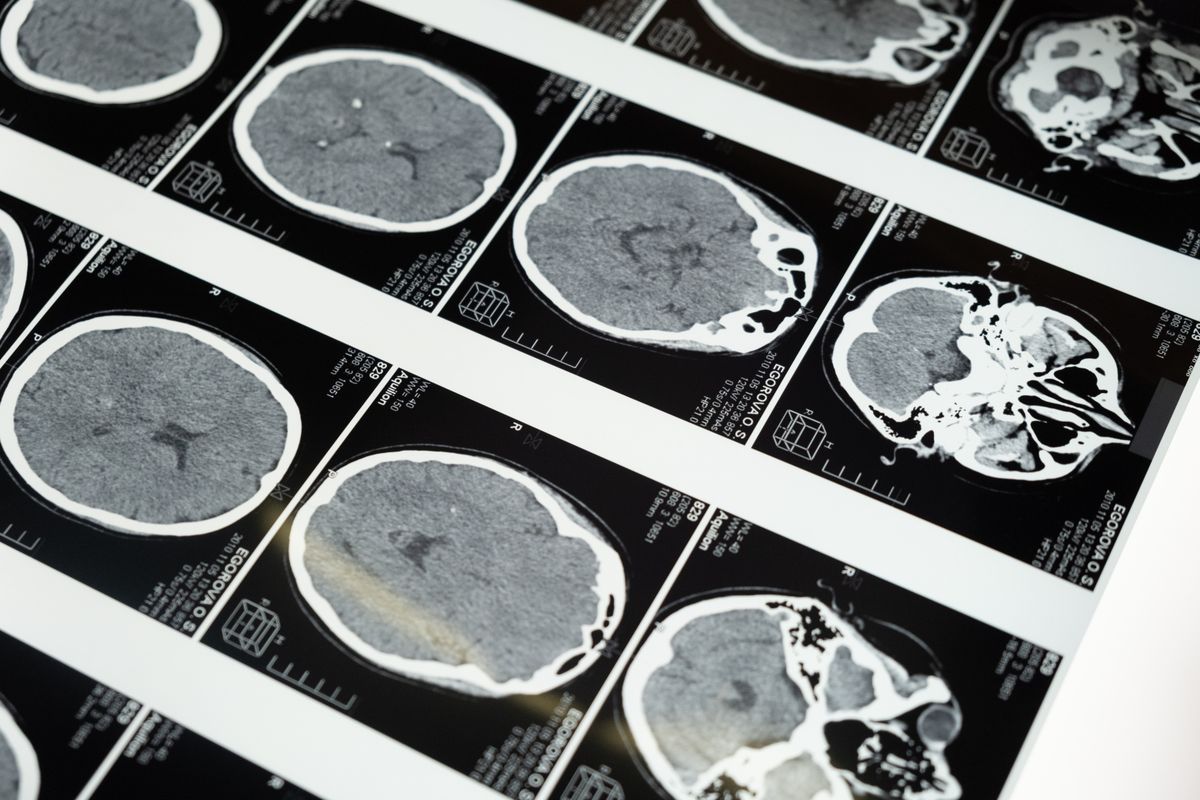Neurology