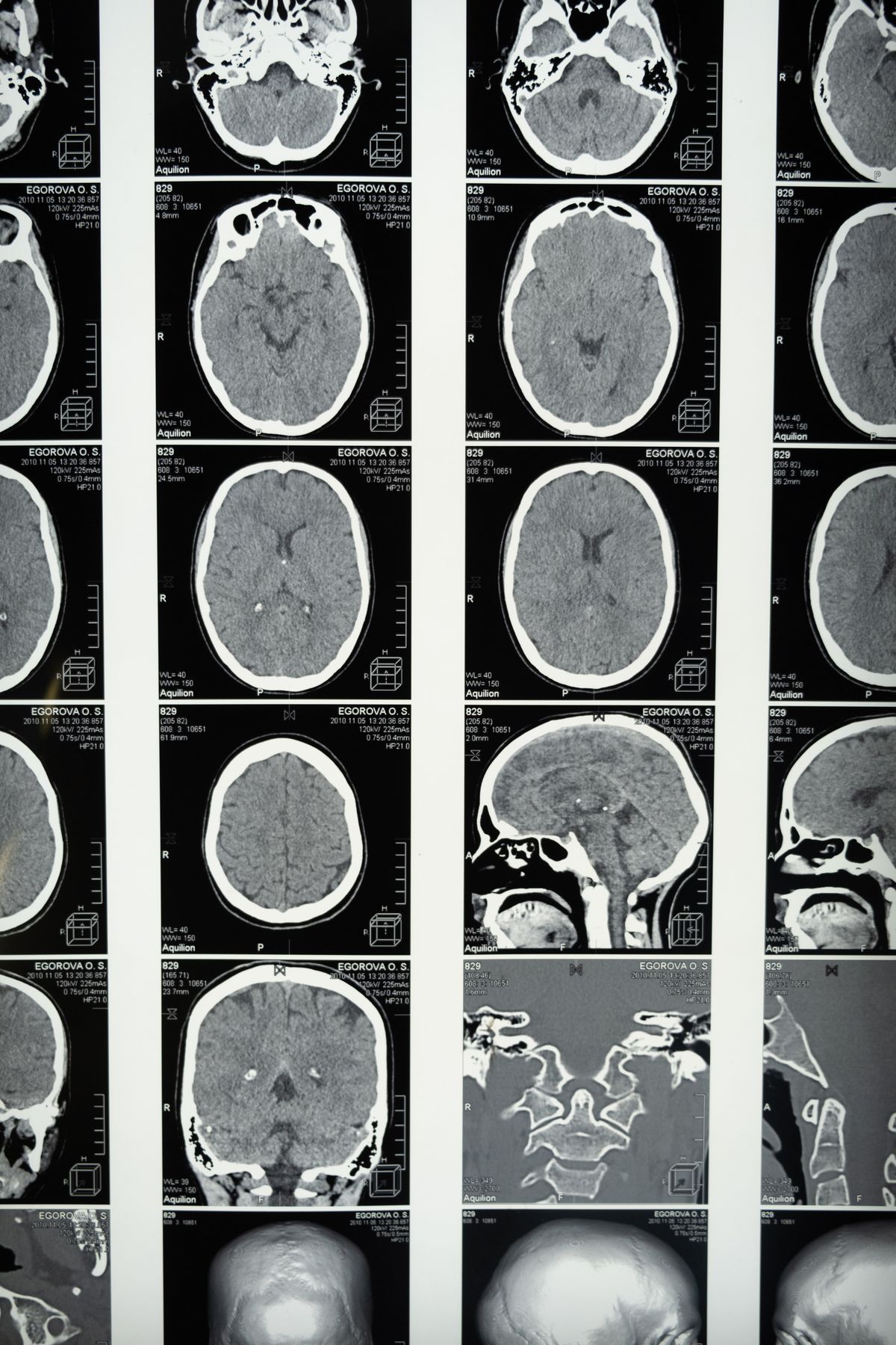 Epilepsy Surgery