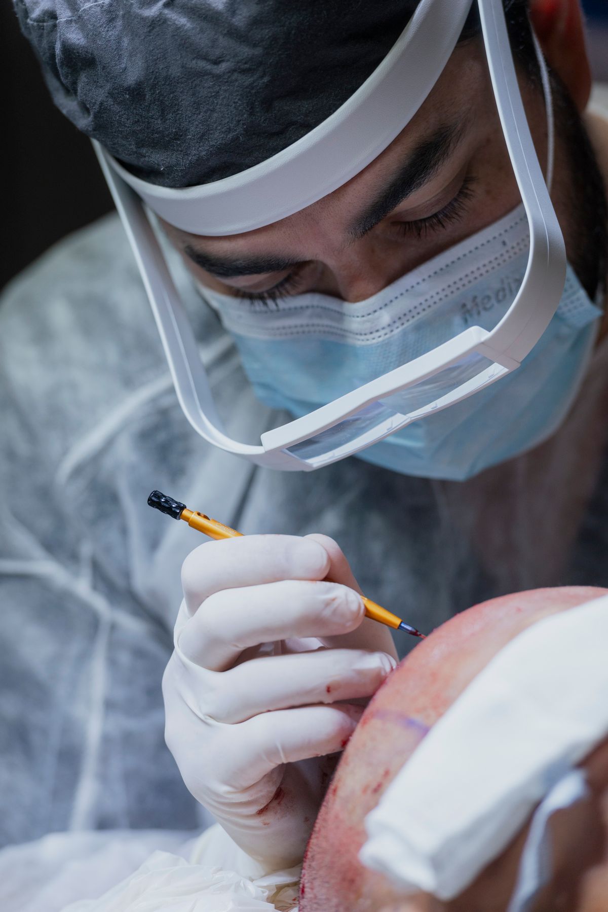 Brain Tumour Surgery