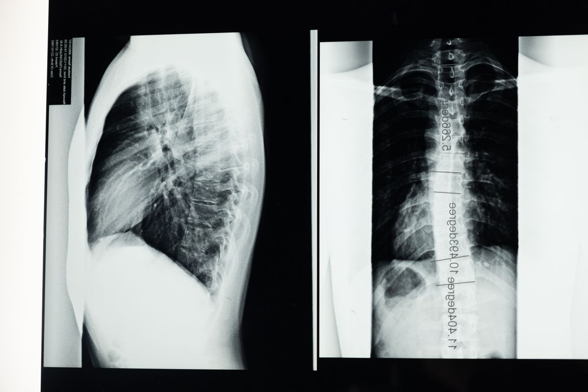 Cervical Fusion / ACDF