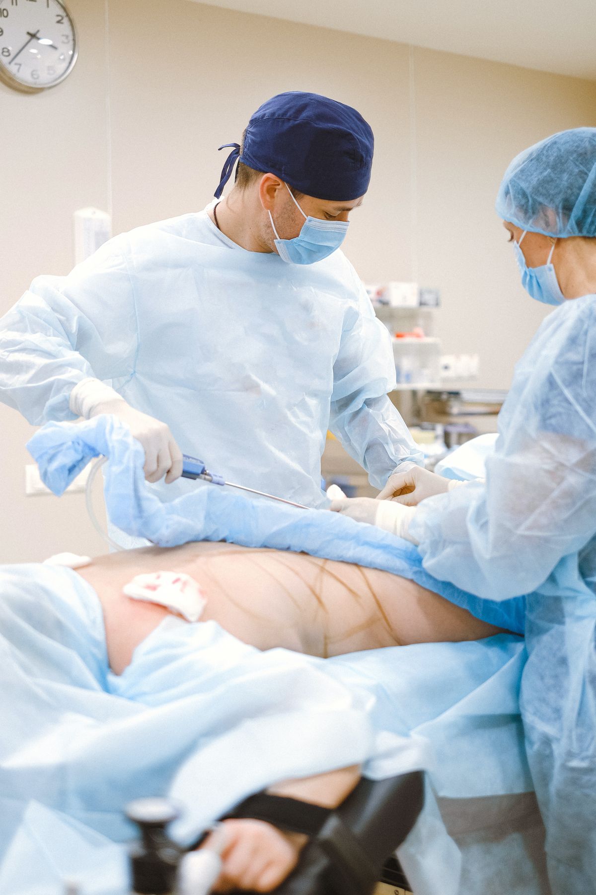 Radical Prostatectomy