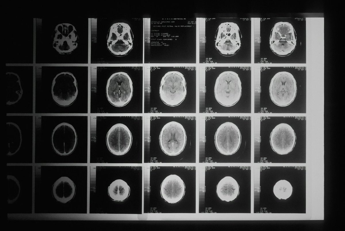 Epilepsy Surgery