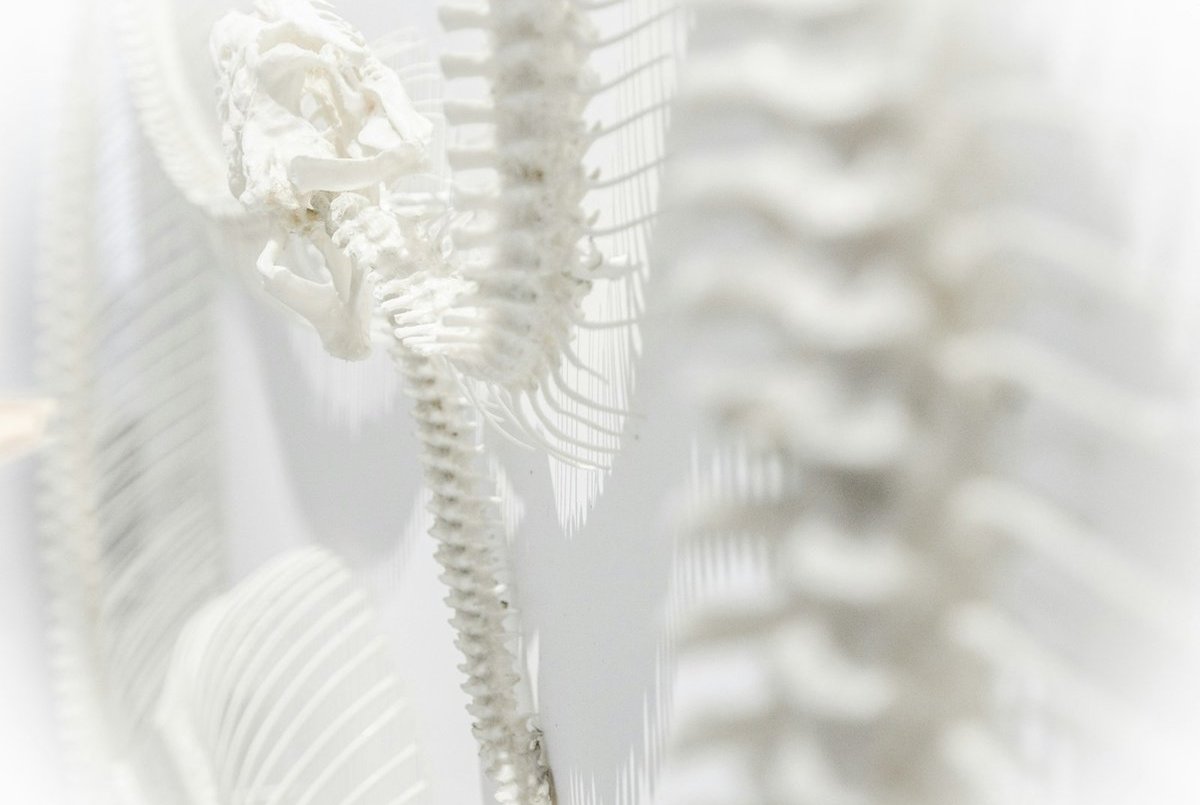 Cervical Fusion / ACDF
