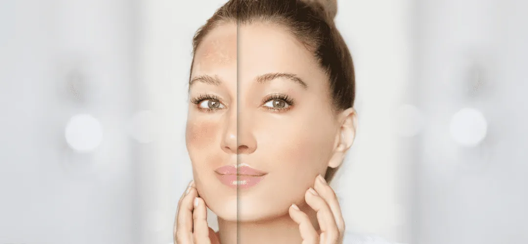 Winter Skin 101