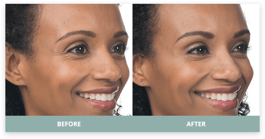 Forehead lines, measured dosing