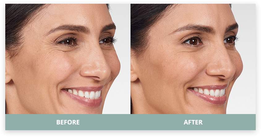 Masseter treatment — jawline contour