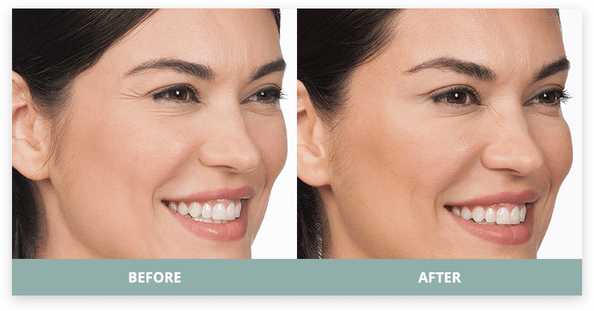 Combination upper-face treatment