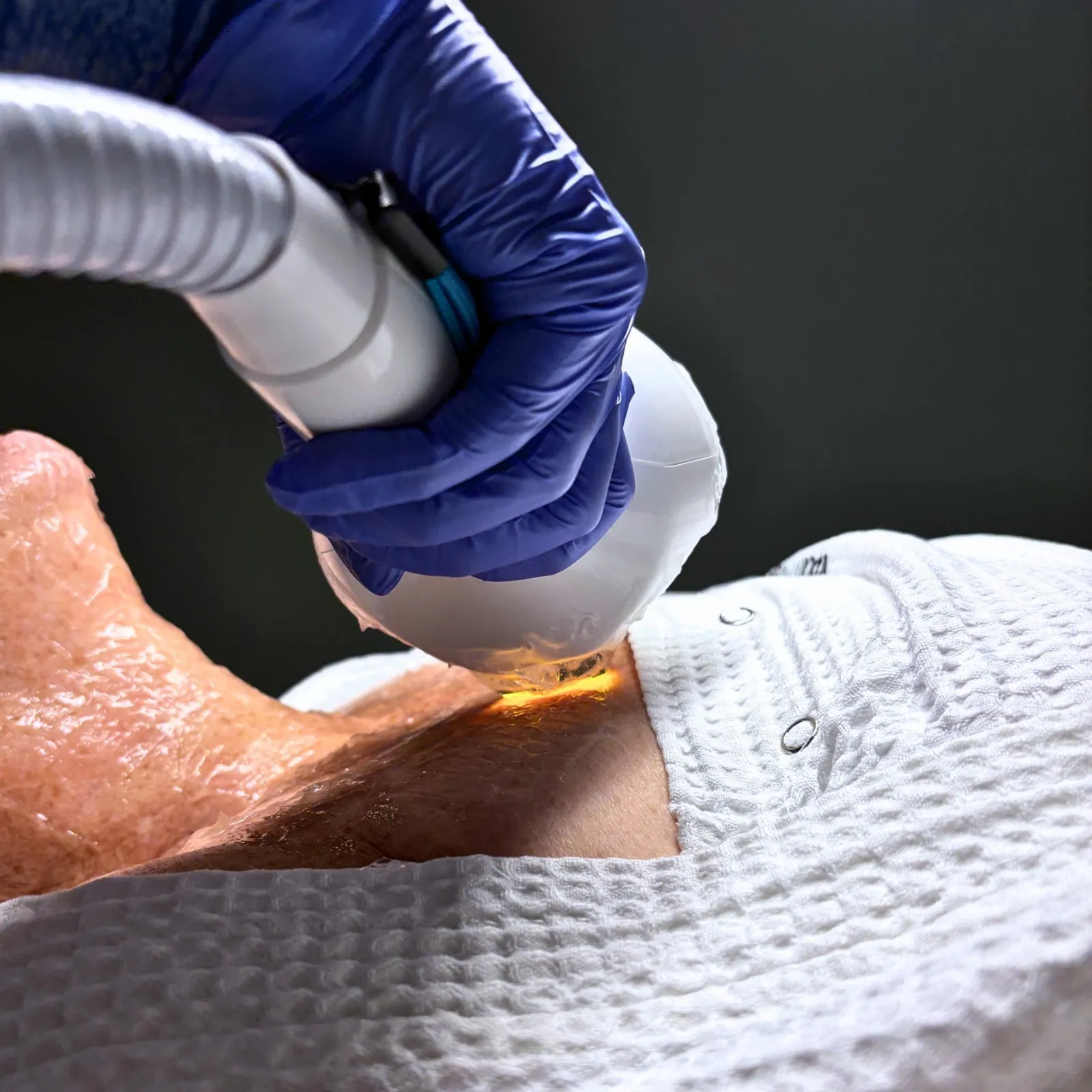 IPL Photofacial