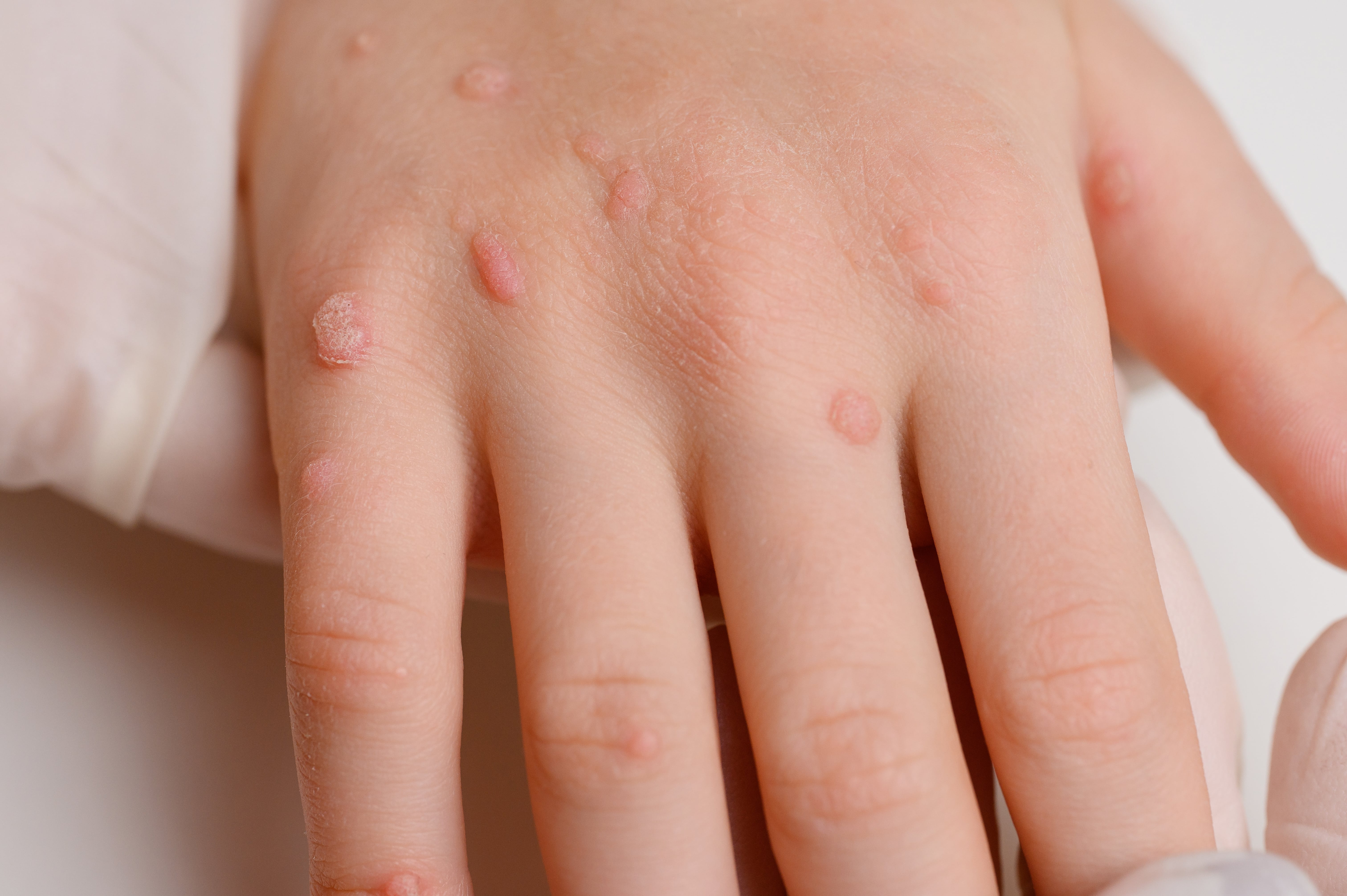 Vascular Lesion Removal Explained