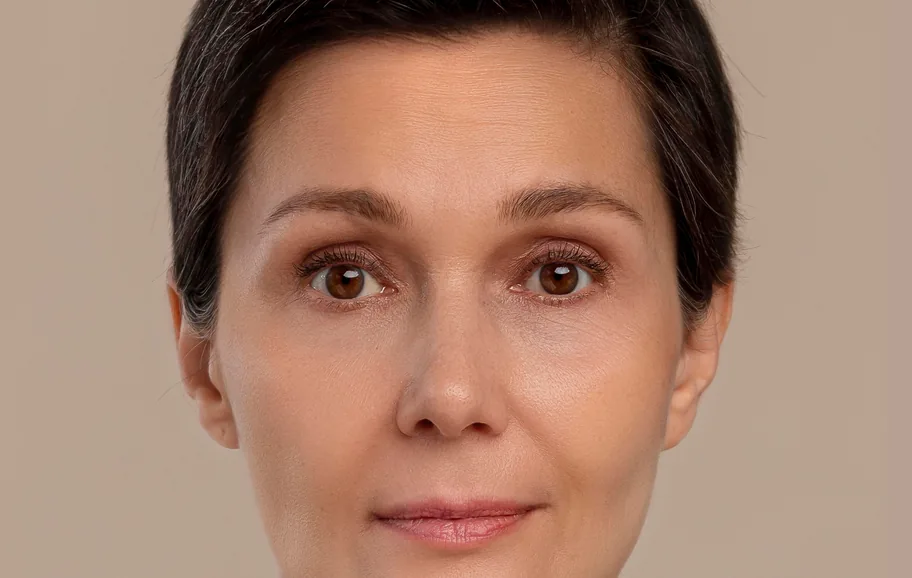 Four weeks after cheek and tear-trough filler, front view