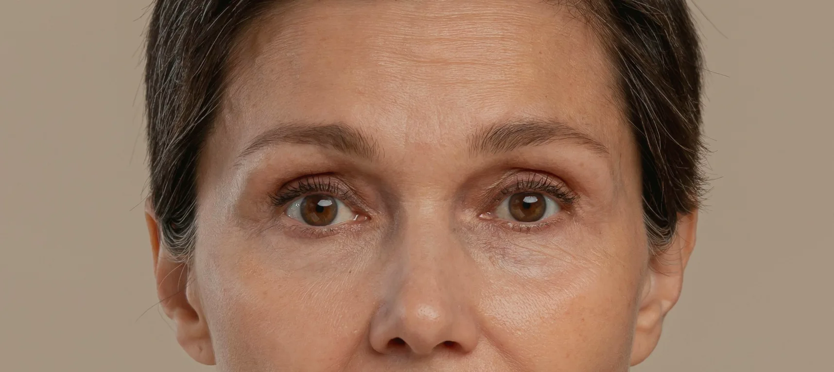 Before: neuromodulator, glabella and forehead lines