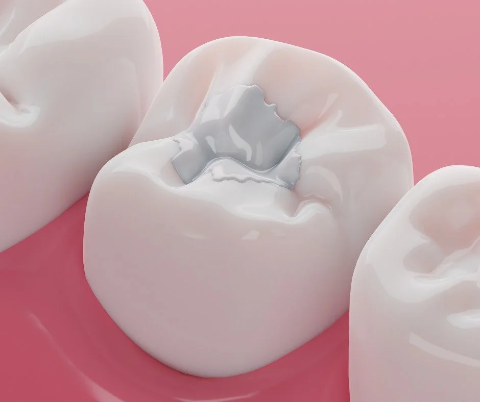 Illustration of a molar with a tooth-colored filling