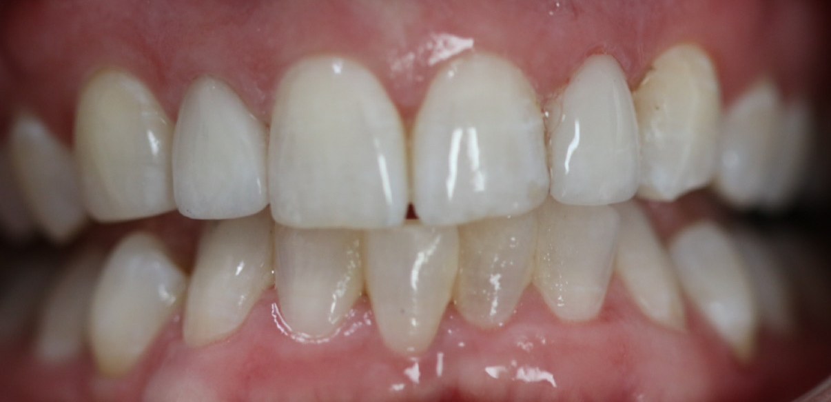 After: front teeth crowns for a brighter, even smile at White Rose Dentistry