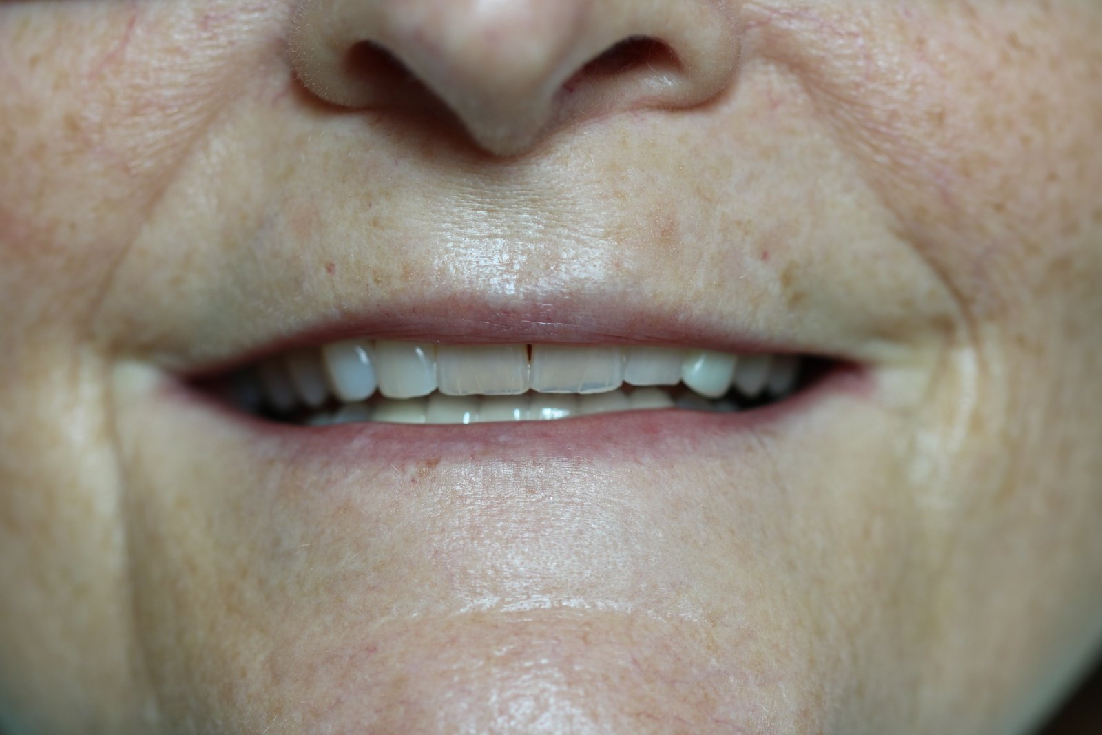 After: bottom teeth replaced at White Rose Dentistry