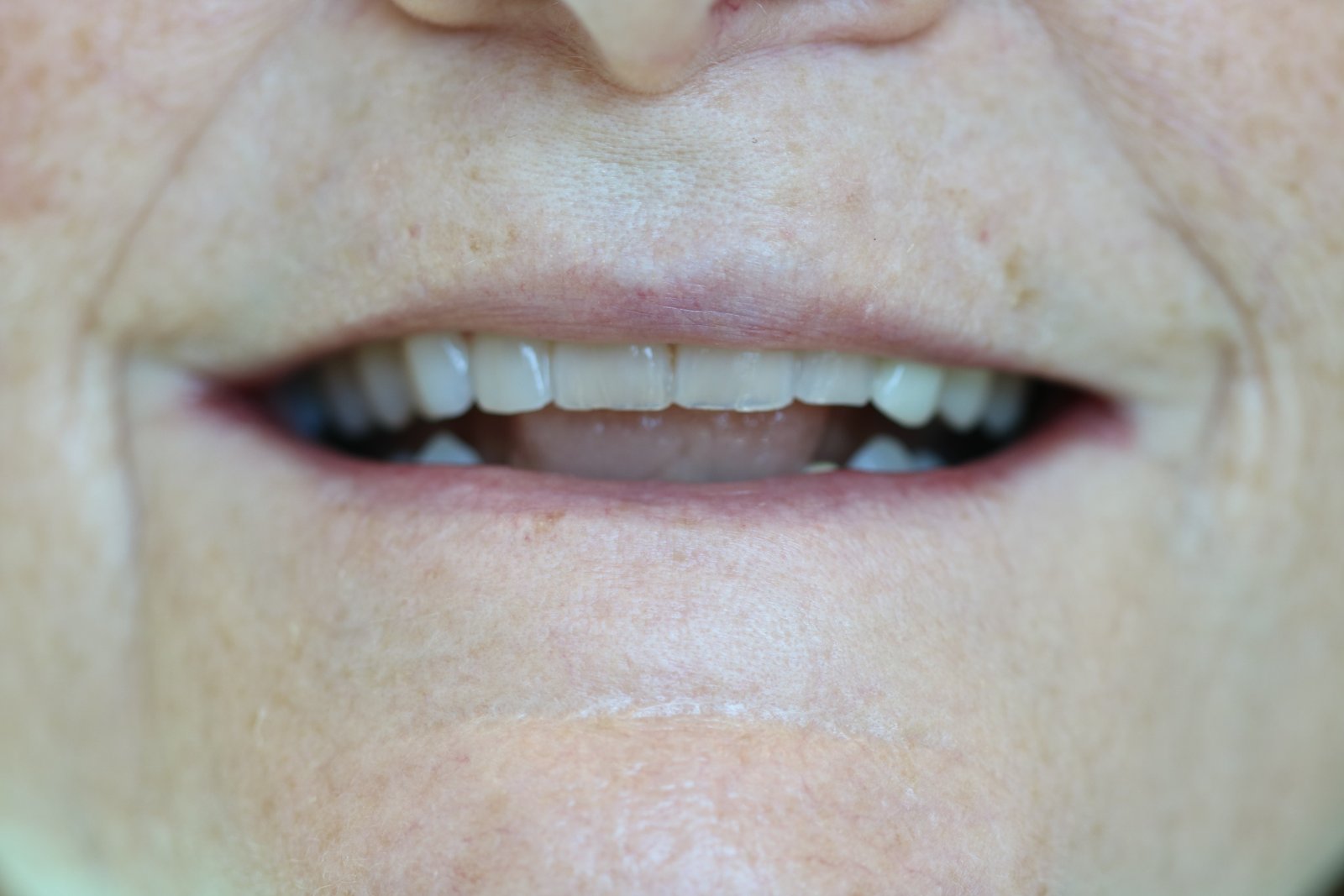 Before: smile with missing bottom teeth