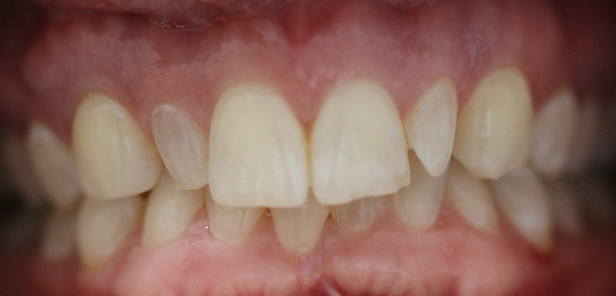 Before: uneven, yellowed front teeth