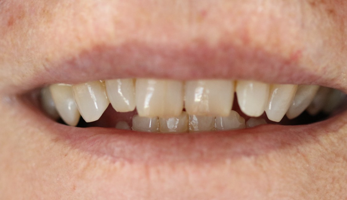 Before: worn, uneven and gapped teeth
