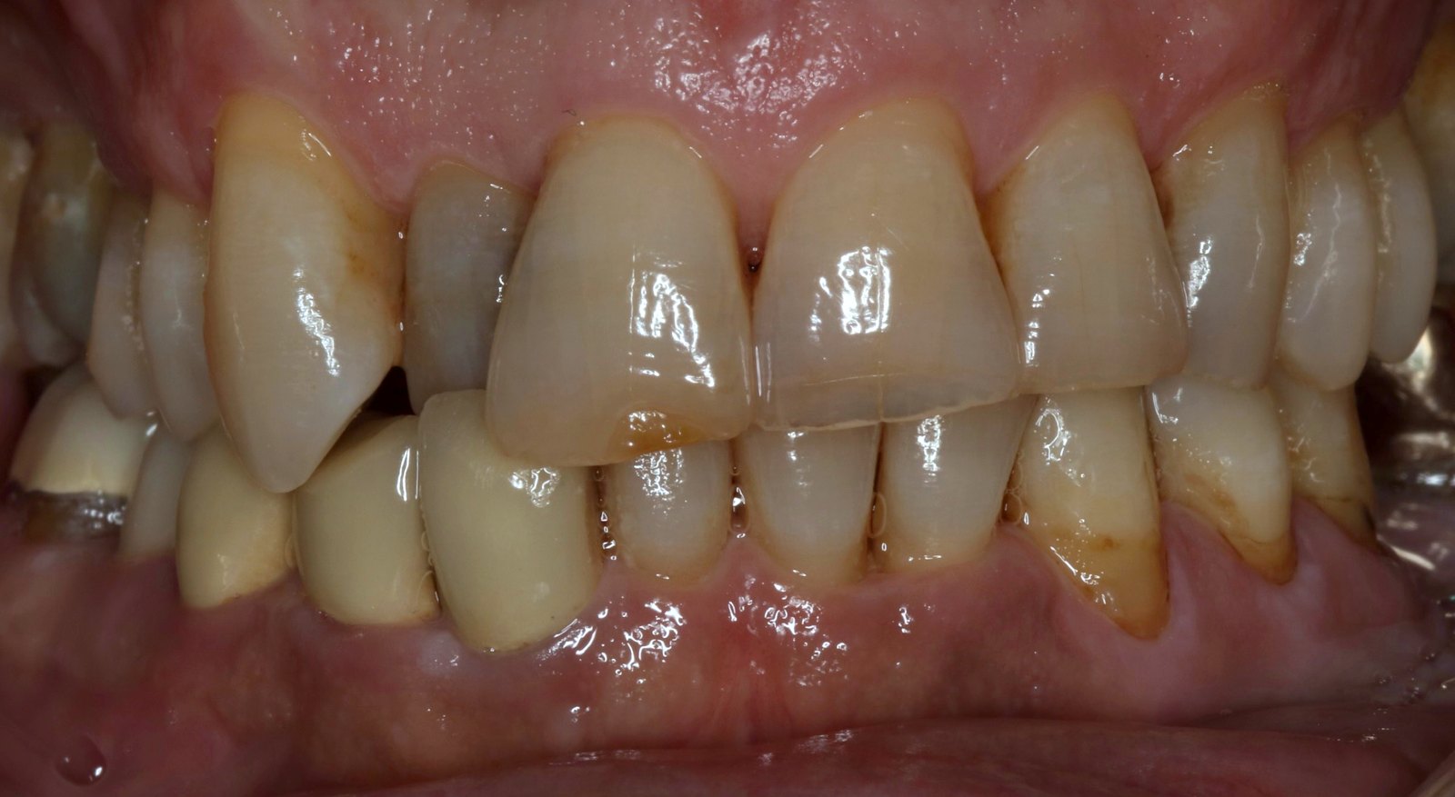 Before: chipped, discolored front teeth