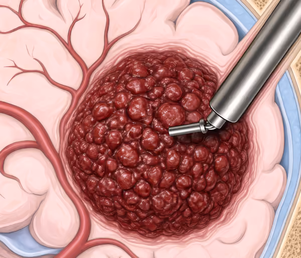 Illustration of endoscopic port-based cranial surgery showing a surgical instrument inserted into a cluster of red, bumpy tissue inside the brain with visible blood vessels and layers of brain and skull tissue.