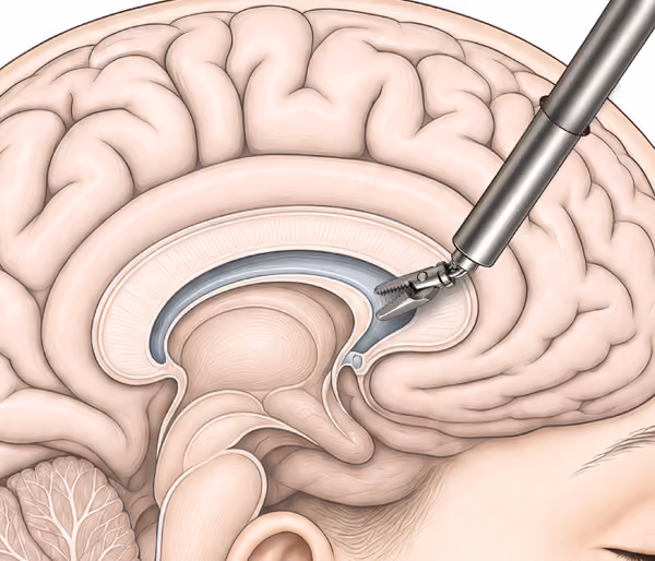 Illustration showing a cross-section of a human brain with a neurosurgical instrument inserted into the ventricular system for ventricular neuroendoscopy.