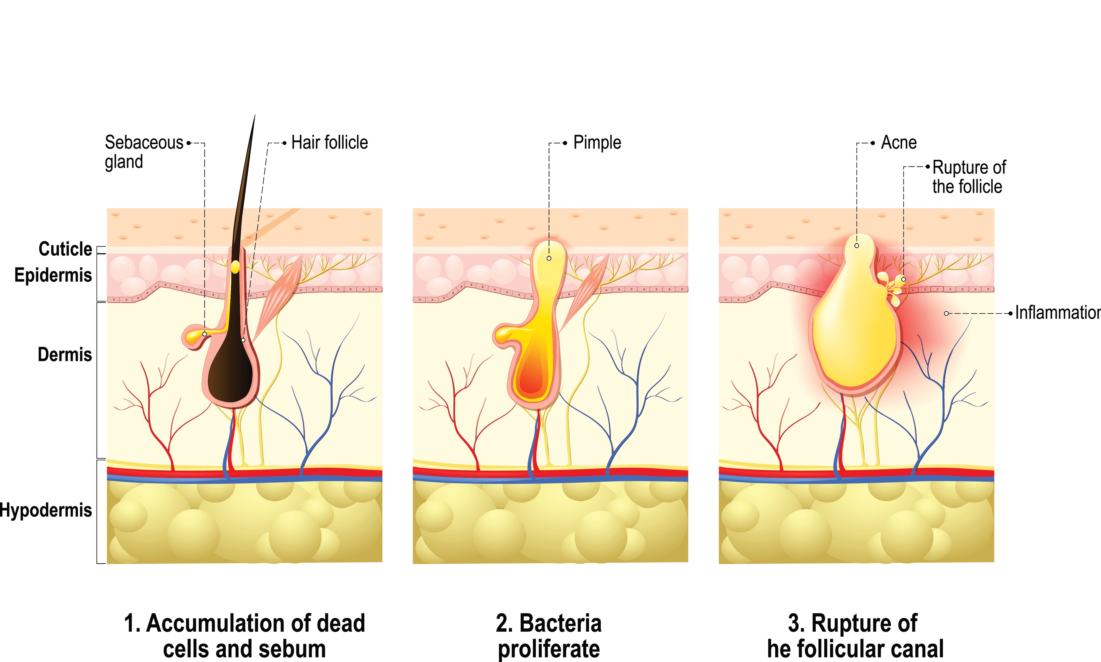 C. acnes and extracellular vesicles roles in acne