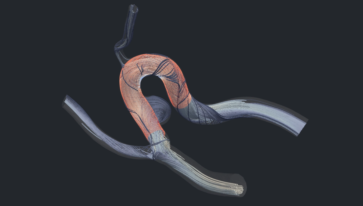 Post-implant flow in the same virtual patient: simulated pathlines through the vessel and aneurysm with the implant in place.