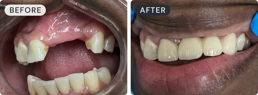 Before (left) and after (right): a wide gap from several missing upper front teeth restored to a complete smile