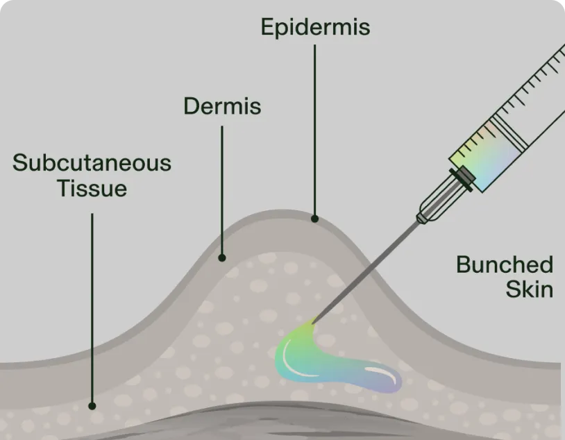 Illustration of a subcutaneous injection into bunched skin