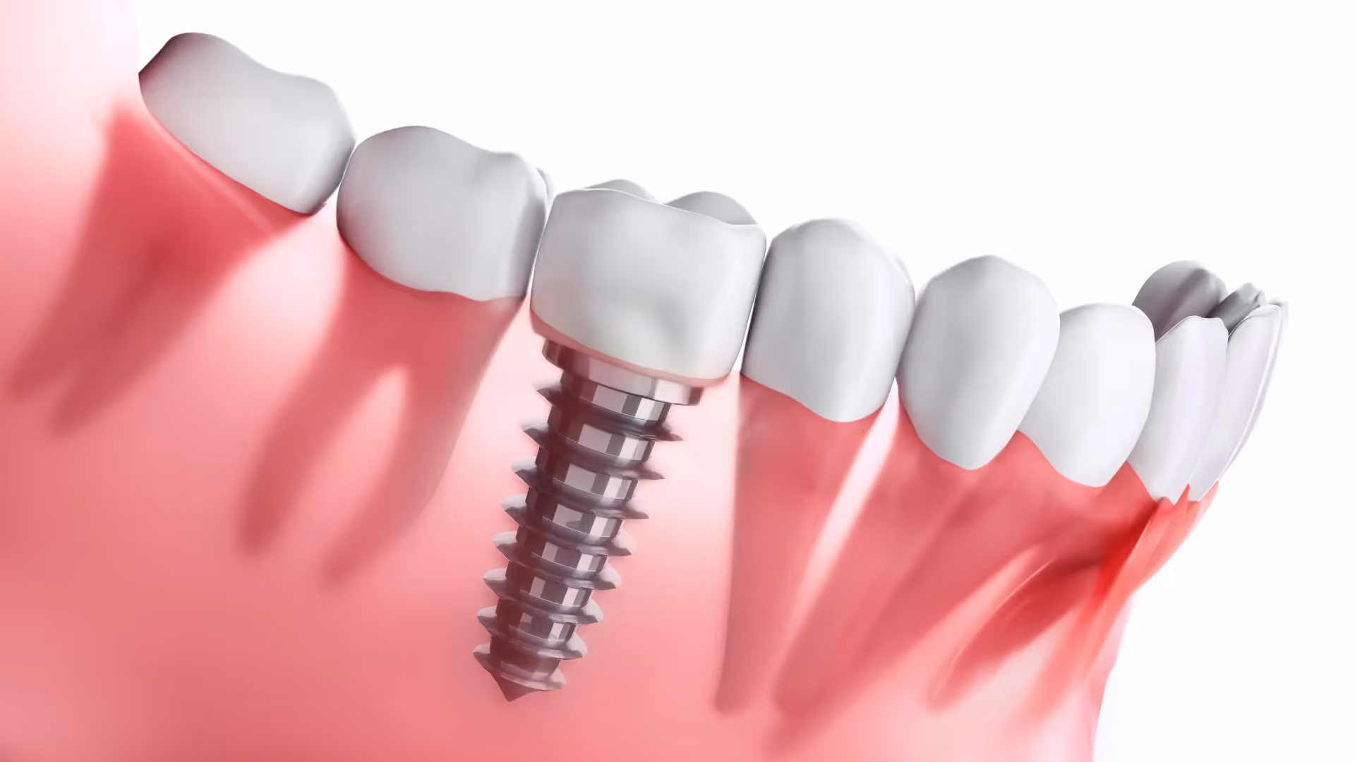 Dental Implants in Clermont: Cost, Procedure & What to Expect