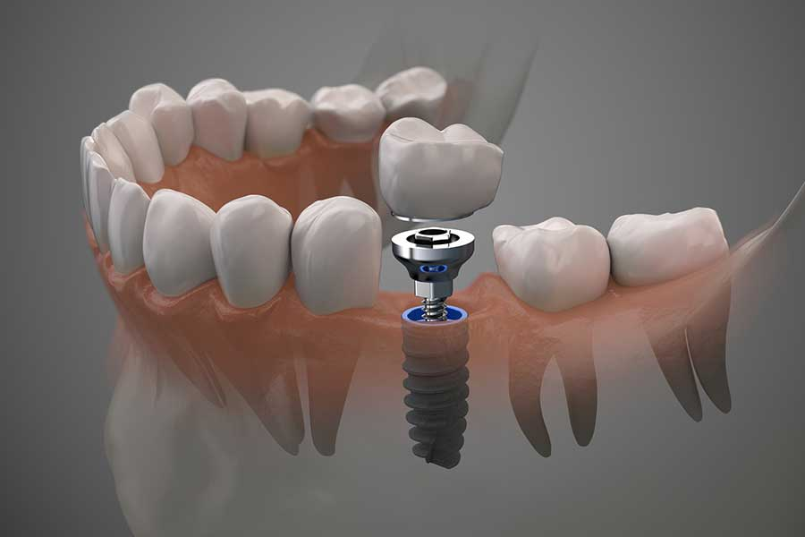Technology to look for in a modern implant practice