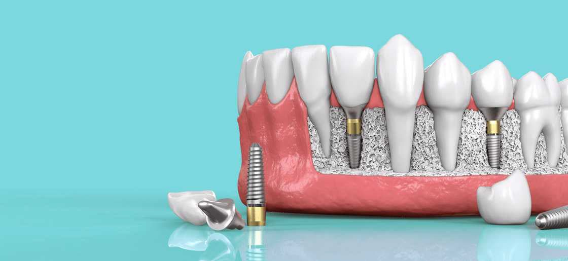 Cost is one of the biggest factors when considering dental implants