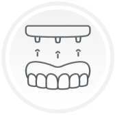Illustration of dental implants being placed into a full set of upper teeth.