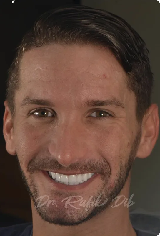 After photo: same patient with a complete implant-supported smile makeover