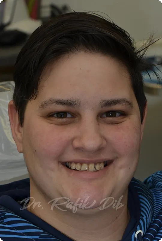  Before photo: patient with significant tooth loss before implant treatment
