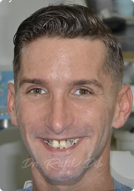 Before photo: patient with worn and missing teeth before full smile restoration
