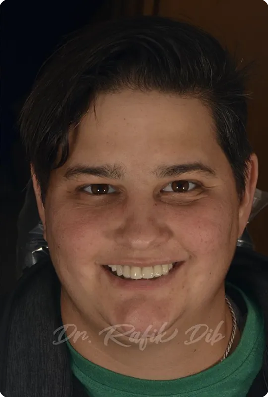 After photo: same patient with a restored full smile after implant treatment