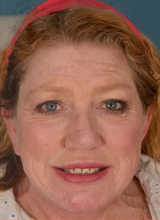 Before photo: patient with significant tooth loss before implant treatment