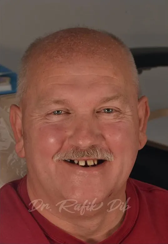  Before photo: patient with damaged and missing teeth prior to treatment at AVA Dental