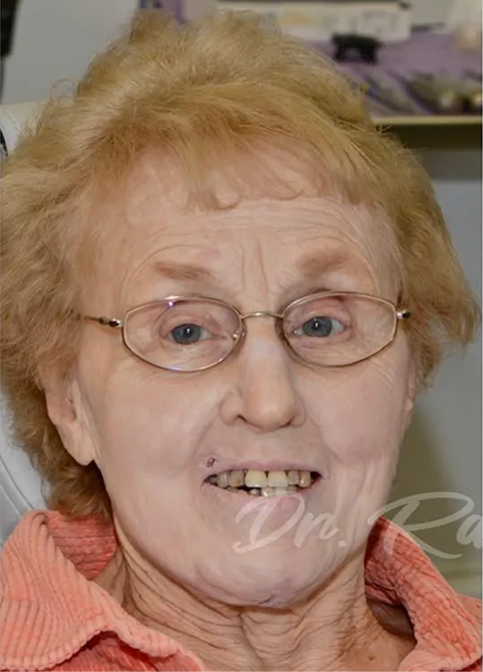 Before photo: patient with worn and missing teeth before full smile restoration