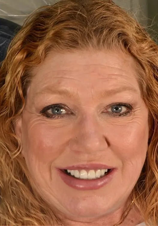 After photo: same patient with a restored full smile after implant treatment