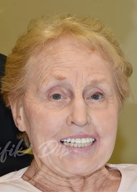 After photo: same patient with a complete implant-supported smile makeover