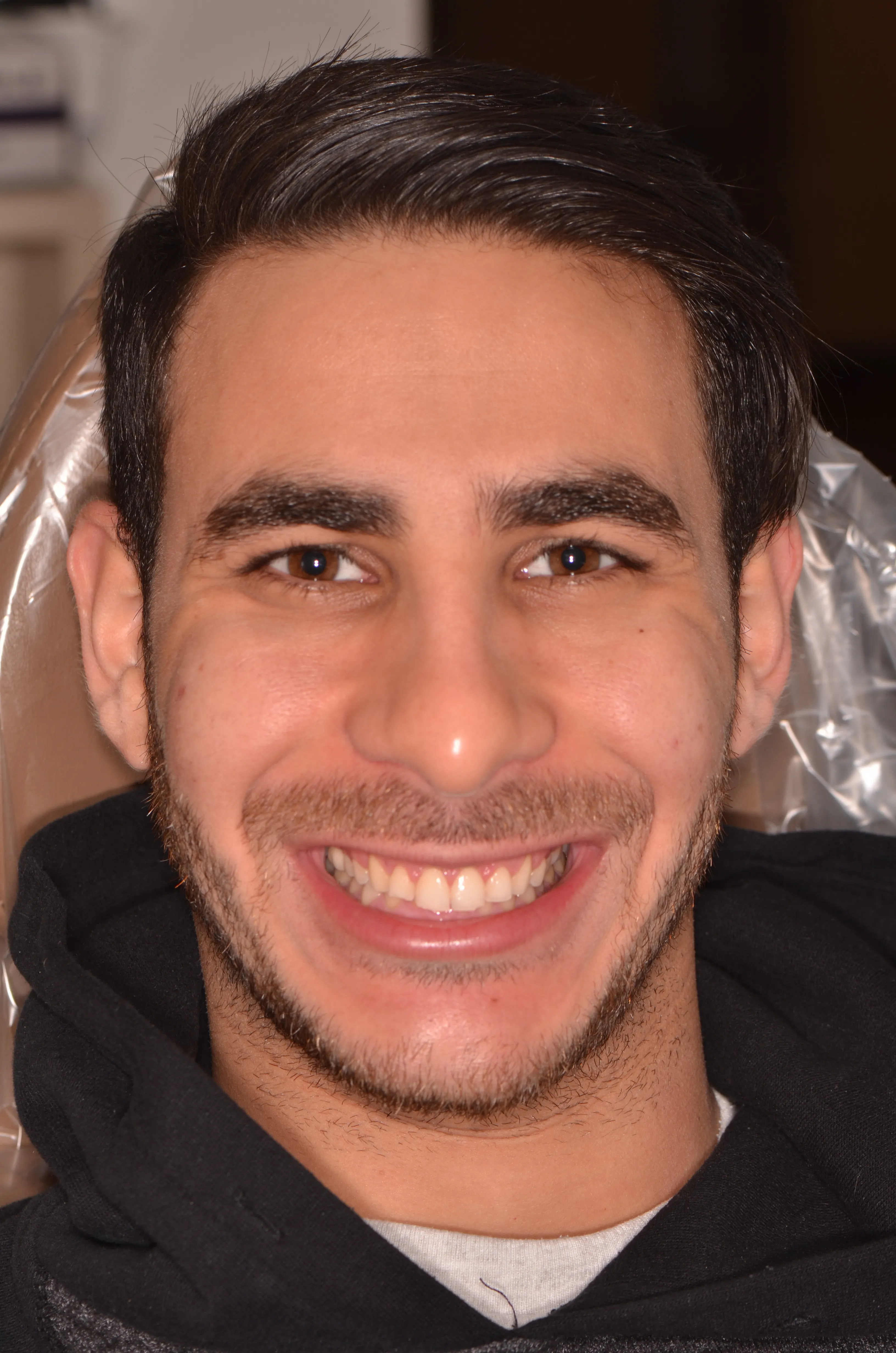 Before: gummy smile before esthetic crown lengthening at AVA Dental 
