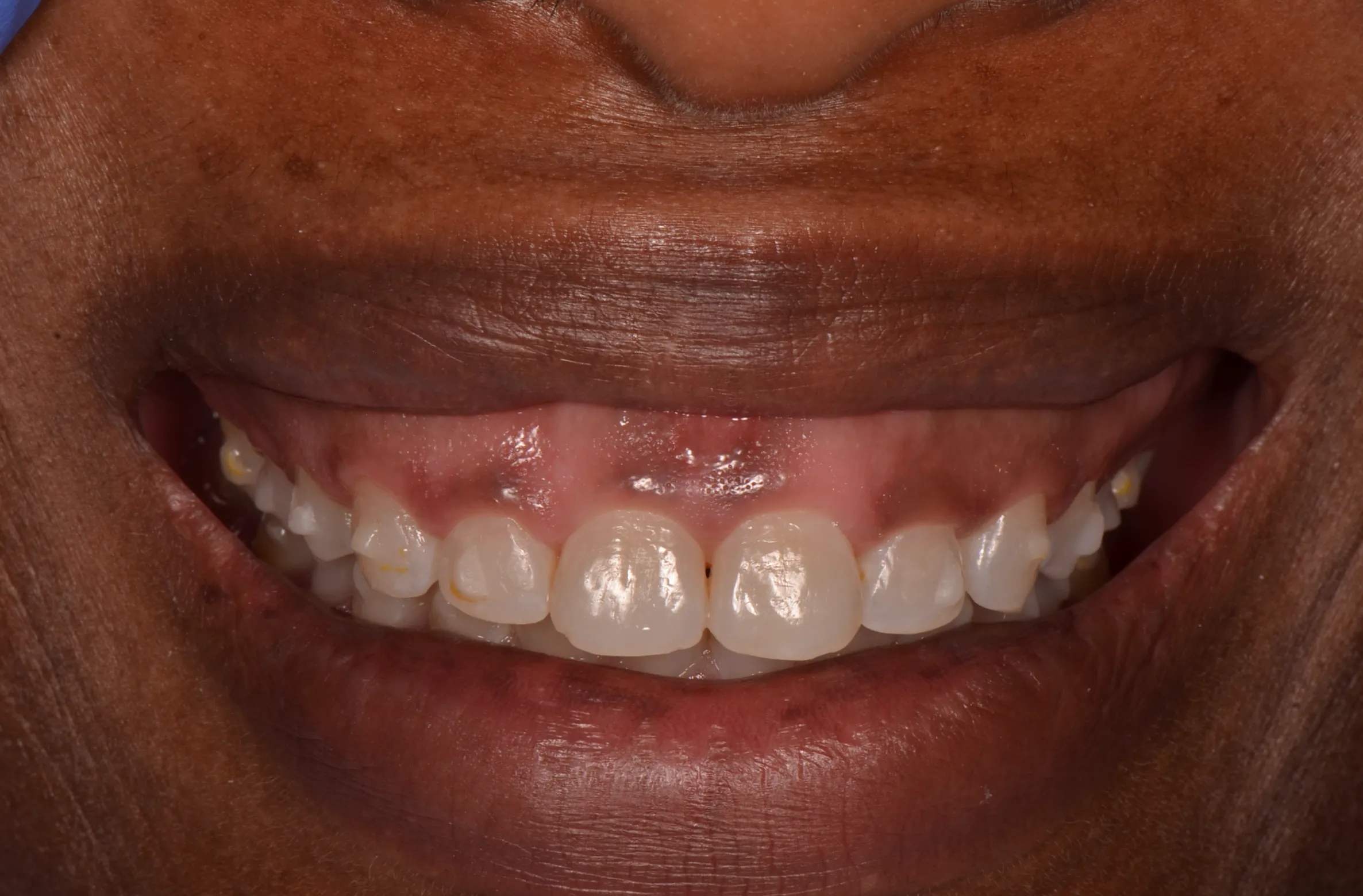  Before-and-after esthetic crown lengthening at AVA Dental