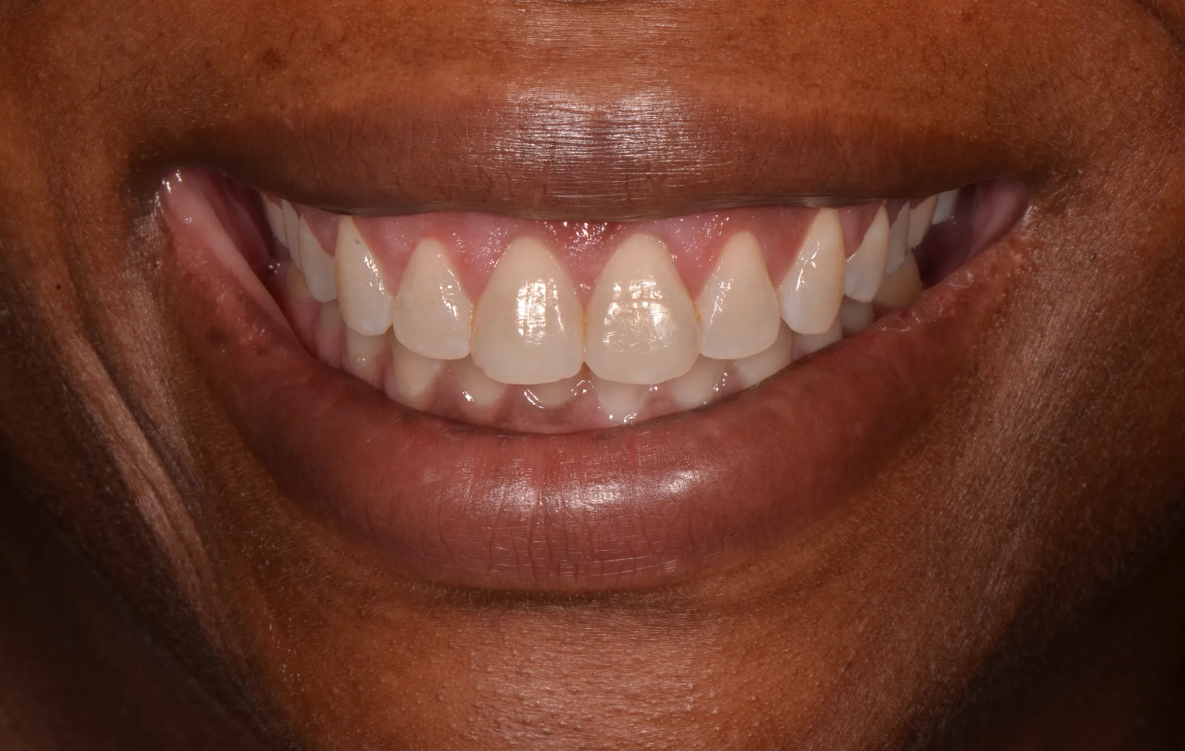 Gum reshaping result from esthetic crown lengthening by Dr. Rafik Dib