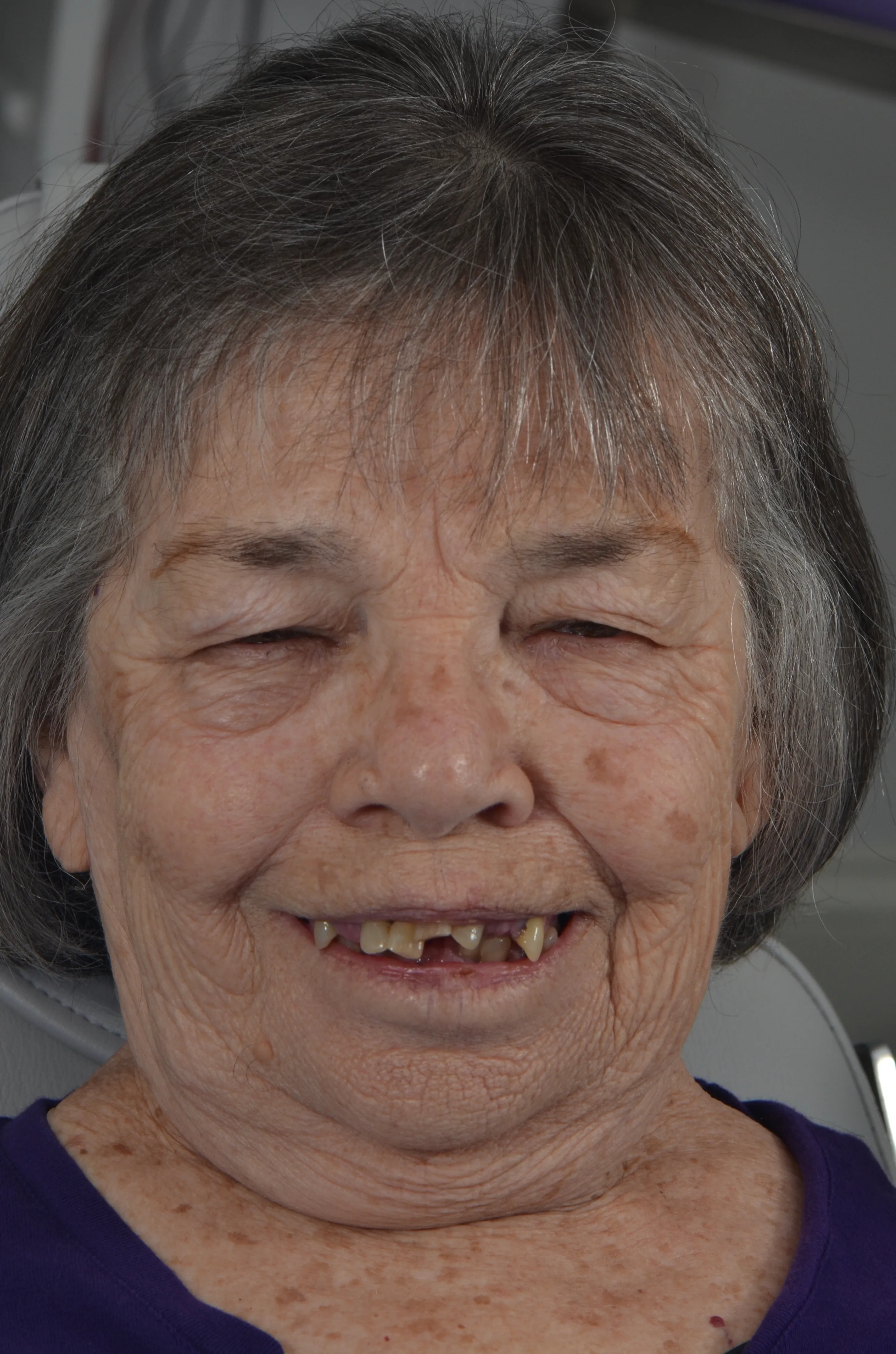 Before: gummy smile before esthetic crown lengthening at AVA Dental 
