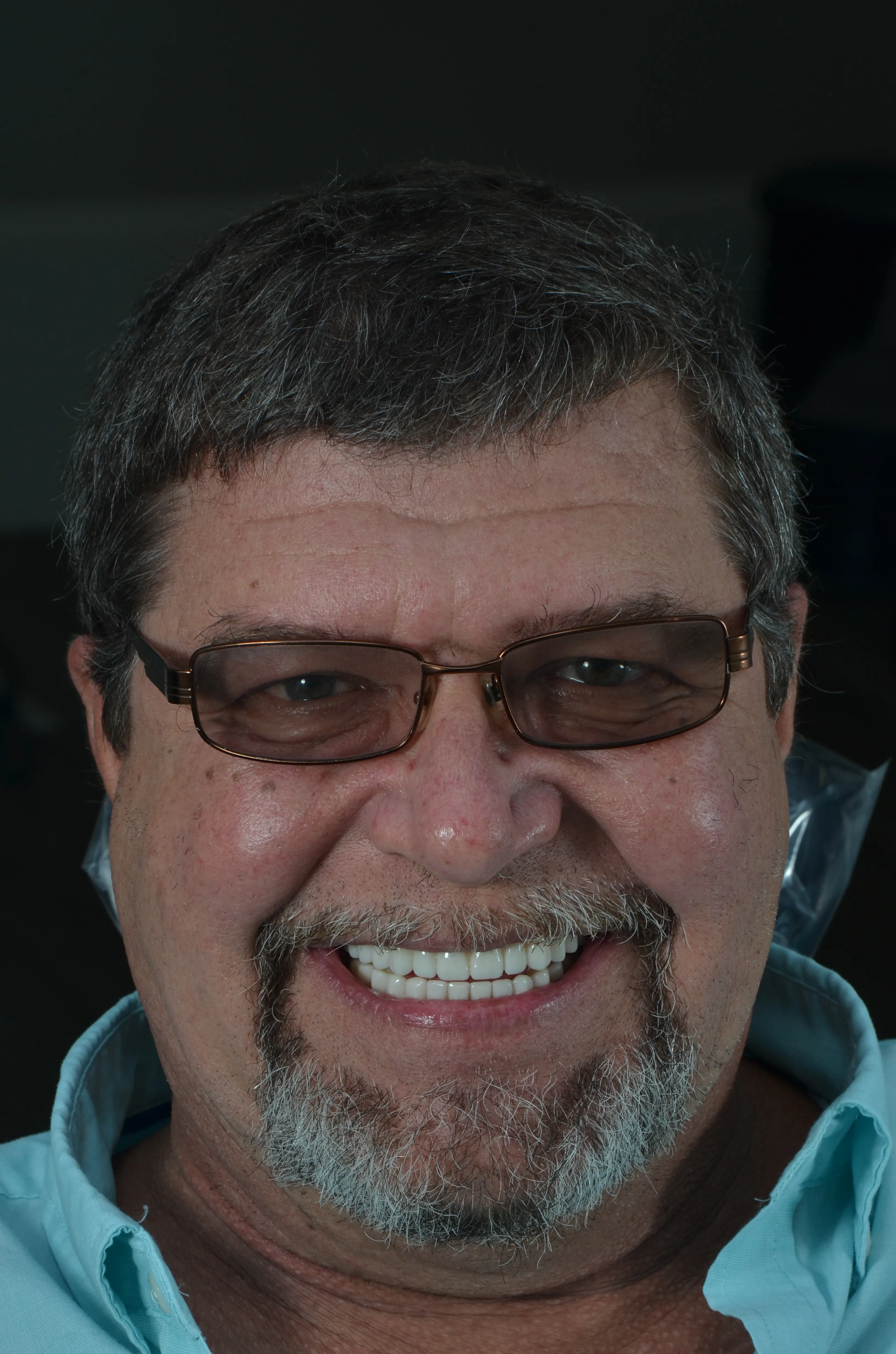 After: balanced gum line after esthetic crown lengthening by Dr. Rafik Dib