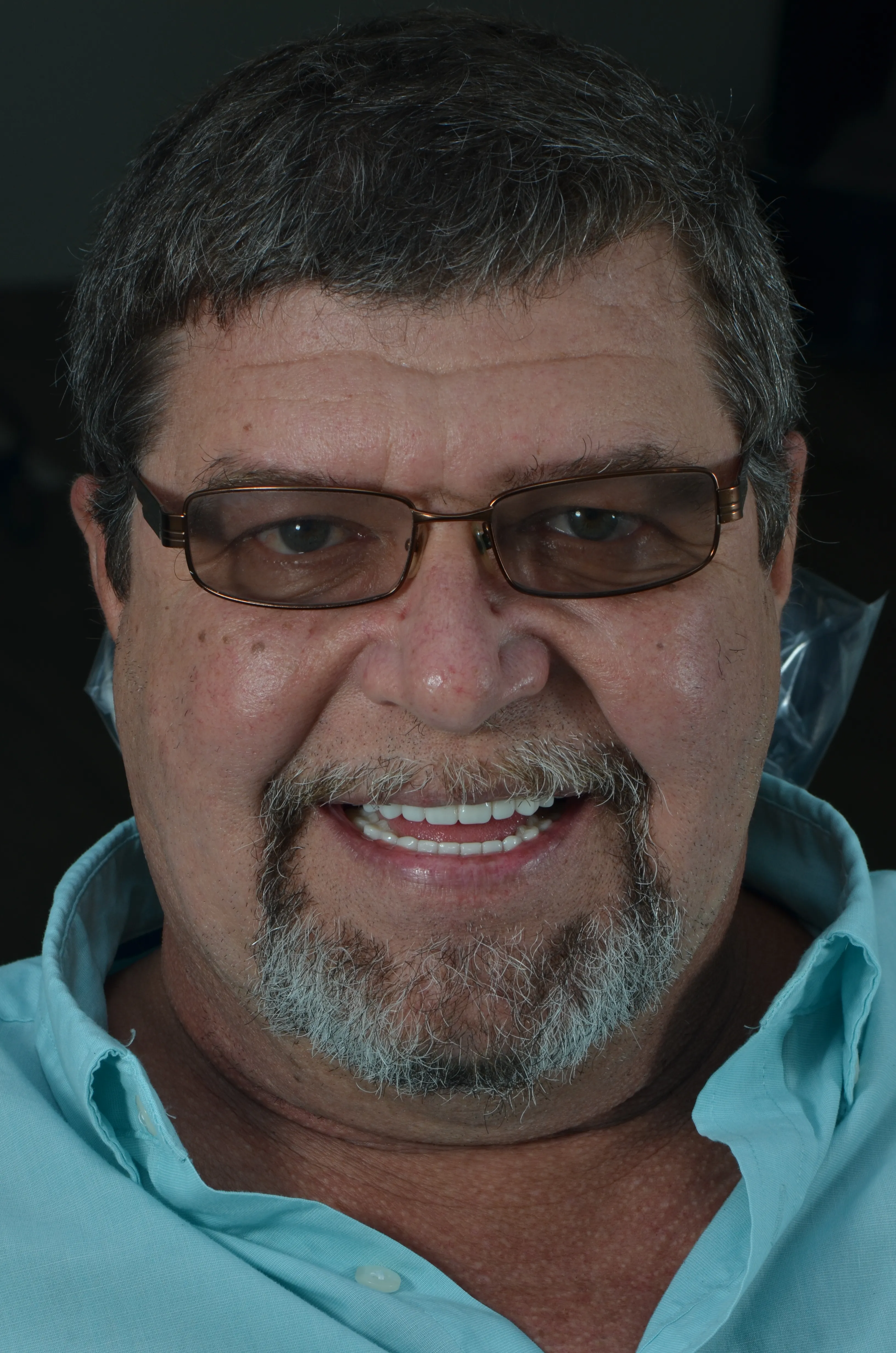 Before: gummy smile before esthetic crown lengthening at AVA Dental 