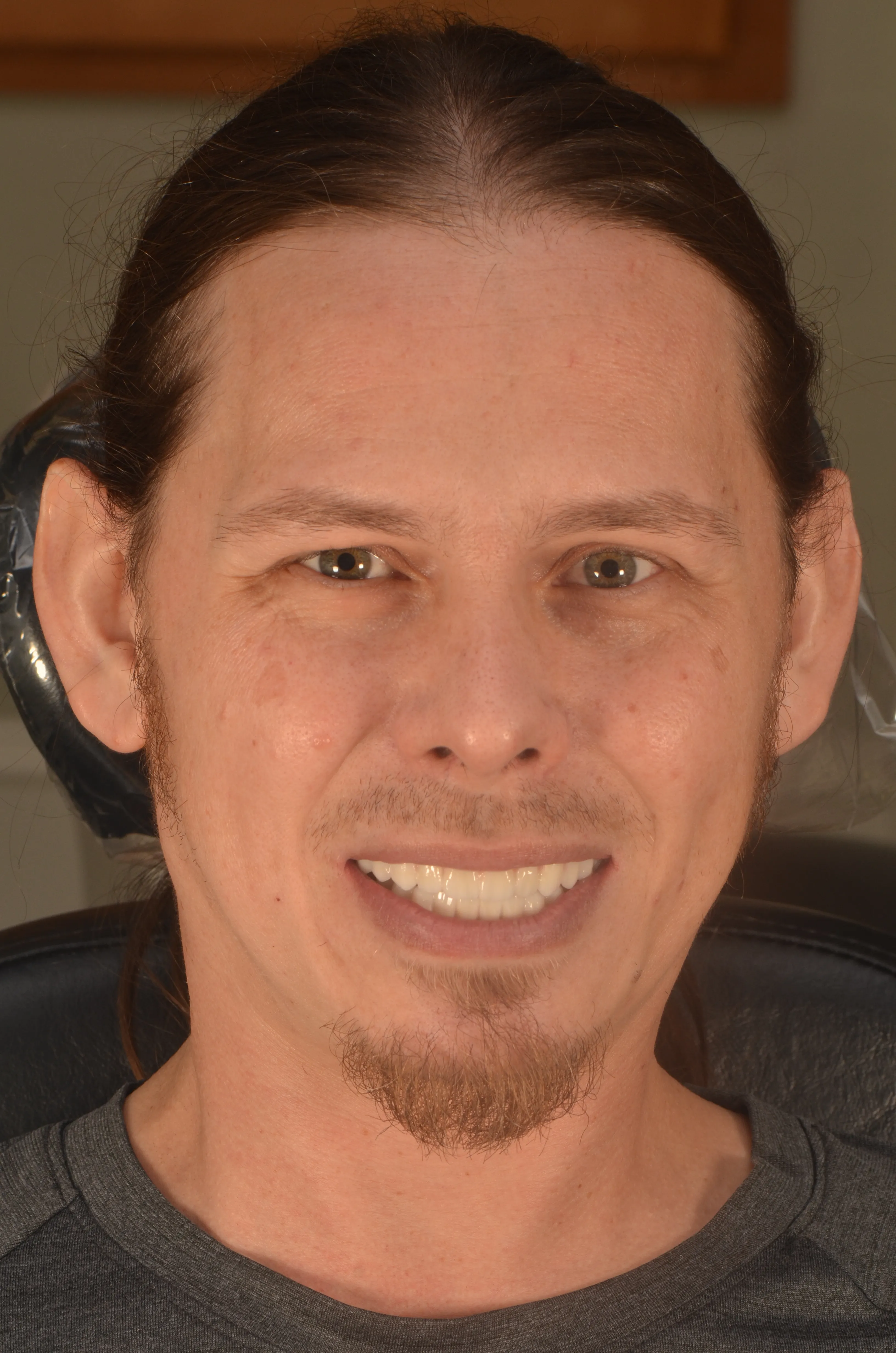 After: balanced gum line after esthetic crown lengthening by Dr. Rafik Dib