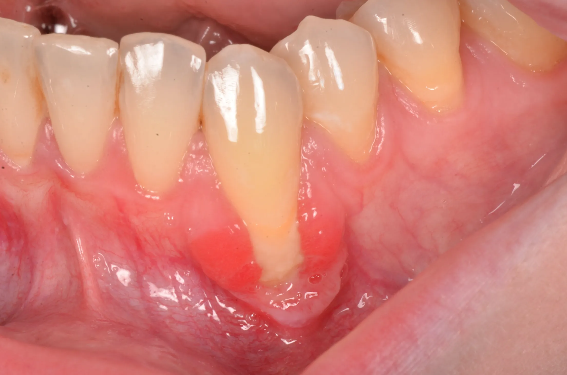  Connective tissue graft result treating gum recession at AVA Dental